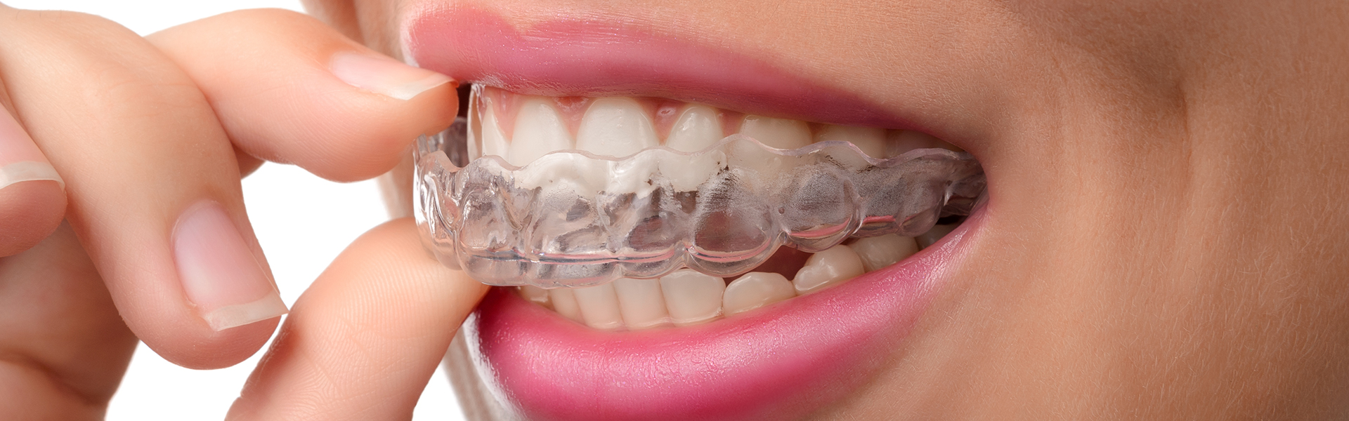 What to Do If Your Invisalign Breaks: Tips from Orthodontic Experts 