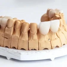 Are-Dental-Veneers-a-Permanent-Cosmetic-Solution