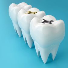 When Do You Need a Crown Instead of a Filling?