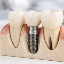 Can Dental Implants Get Cavities? Here’s What You Should Know